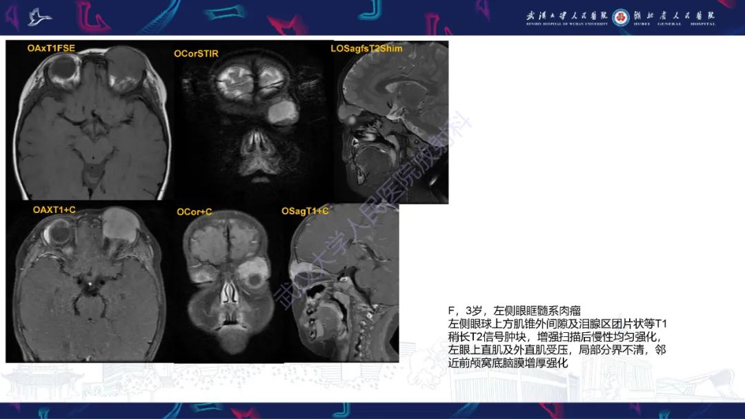 影像PPT - 【PPT】儿童眼眶肿瘤及肿瘤样病变影像诊断-45