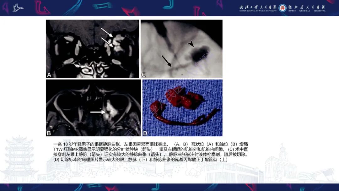 影像PPT - 【PPT】儿童眼眶肿瘤及肿瘤样病变影像诊断-48