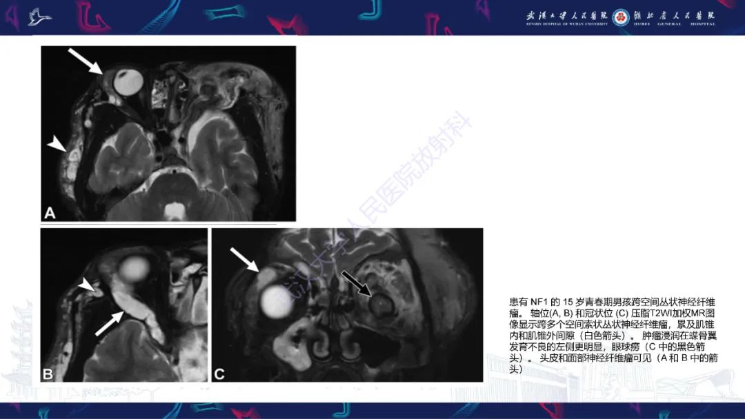 影像PPT - 【PPT】儿童眼眶肿瘤及肿瘤样病变影像诊断-50