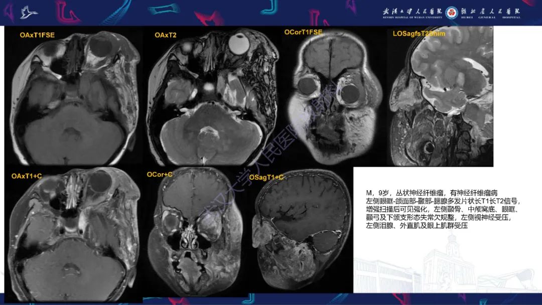 影像PPT - 【PPT】儿童眼眶肿瘤及肿瘤样病变影像诊断-51