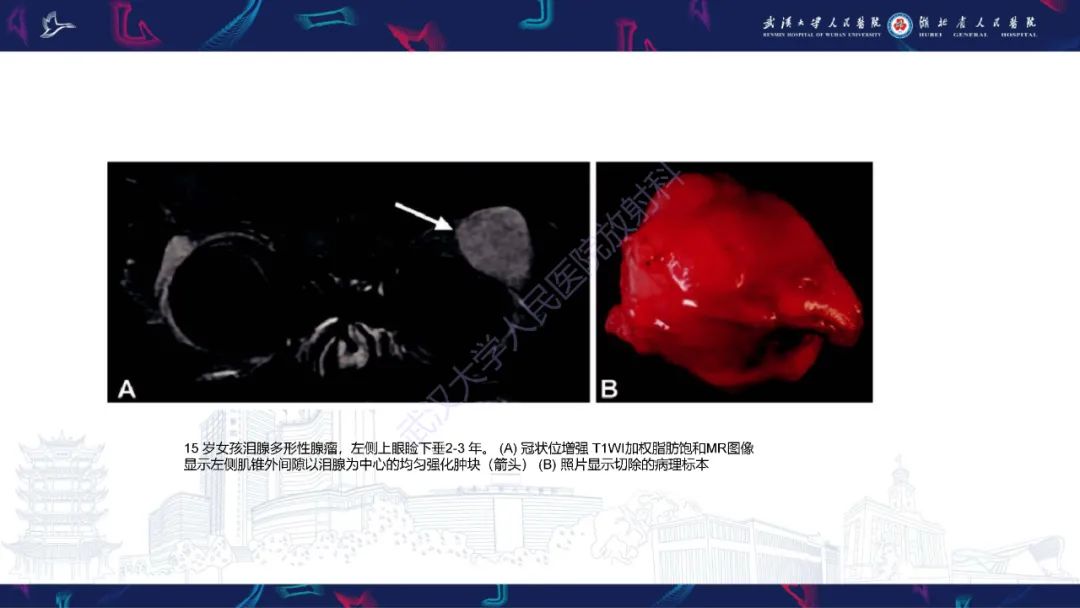 影像PPT - 【PPT】儿童眼眶肿瘤及肿瘤样病变影像诊断-53