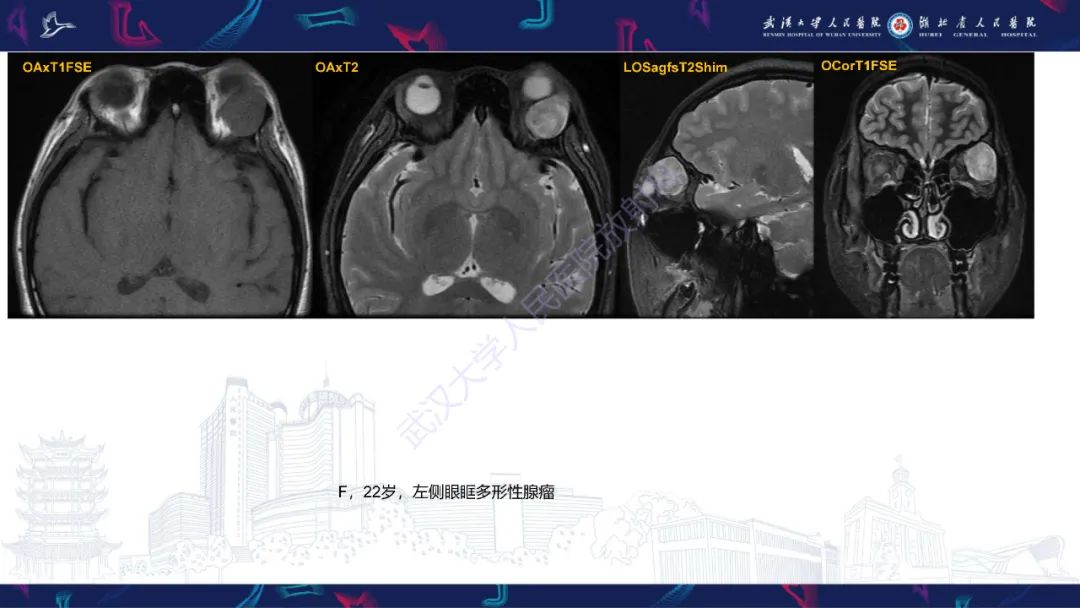 影像PPT - 【PPT】儿童眼眶肿瘤及肿瘤样病变影像诊断-54