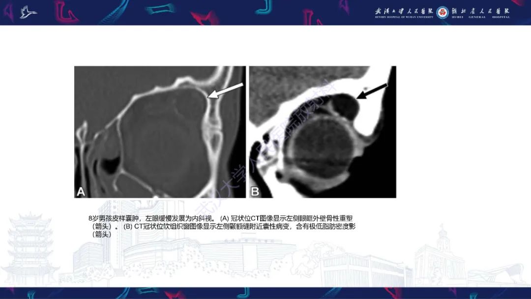 影像PPT - 【PPT】儿童眼眶肿瘤及肿瘤样病变影像诊断-56