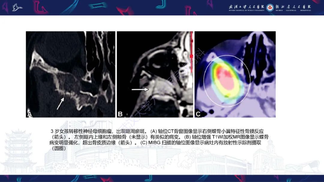 影像PPT - 【PPT】儿童眼眶肿瘤及肿瘤样病变影像诊断-60