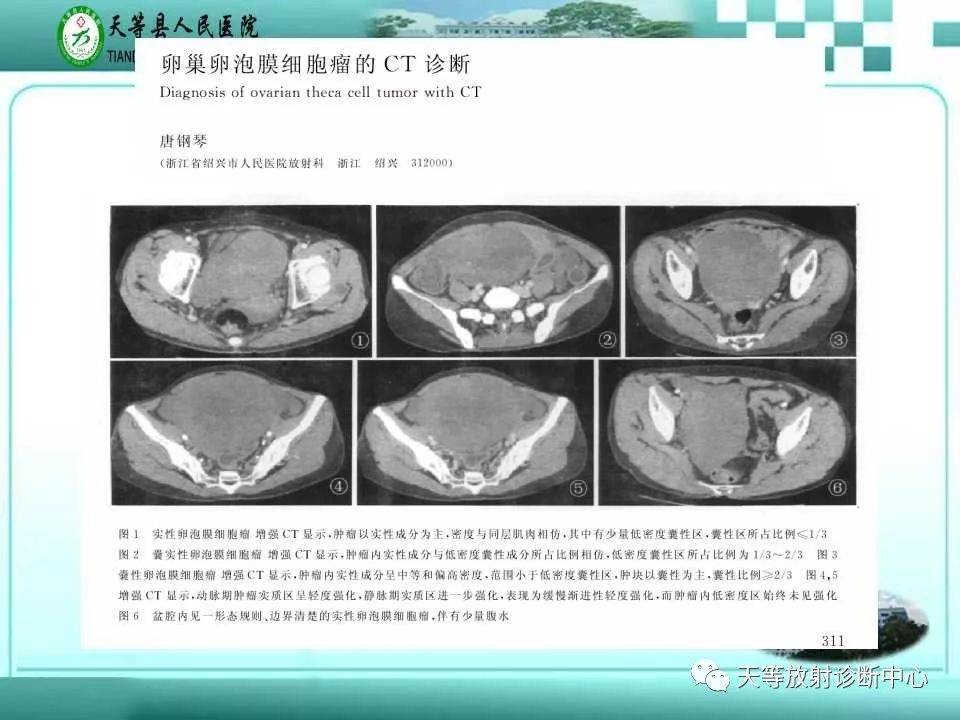 影像PPT - 【病例】卵泡膜细胞瘤1例CT诊断-5 影像PPT - 【病例】卵泡膜细胞瘤1例CT诊断-5