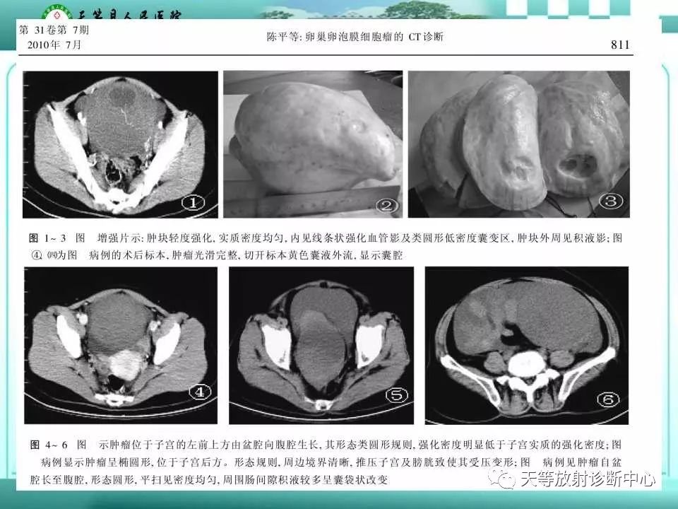 影像PPT - 【病例】卵泡膜细胞瘤1例CT诊断-4 影像PPT - 【病例】卵泡膜细胞瘤1例CT诊断-4