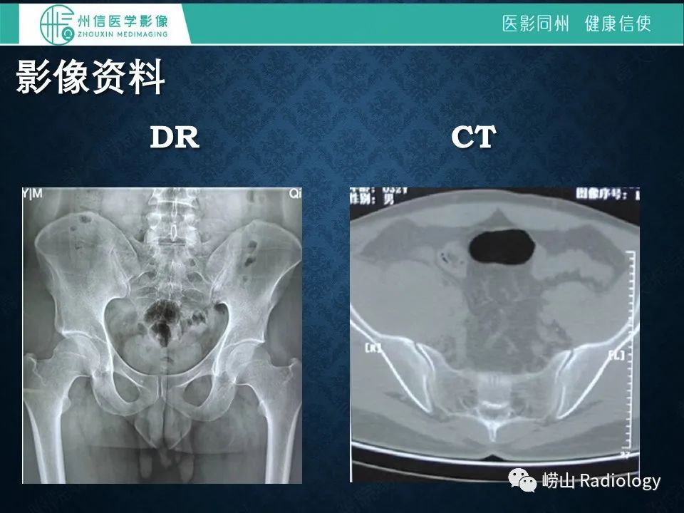 影像PPT - 【病例】腰大肌淋巴瘤1例PET/CT及MR影像-3