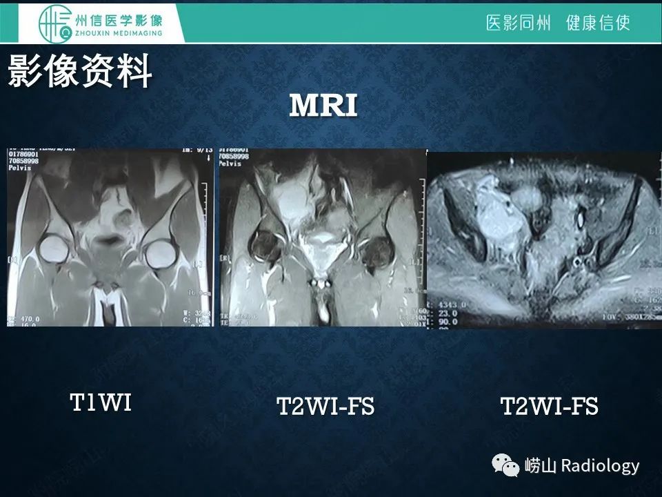 影像PPT - 【病例】腰大肌淋巴瘤1例PET/CT及MR影像-4