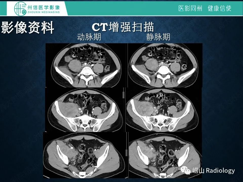 影像PPT - 【病例】腰大肌淋巴瘤1例PET/CT及MR影像-5