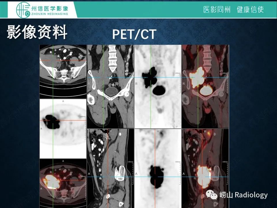 影像PPT - 【病例】腰大肌淋巴瘤1例PET/CT及MR影像-6