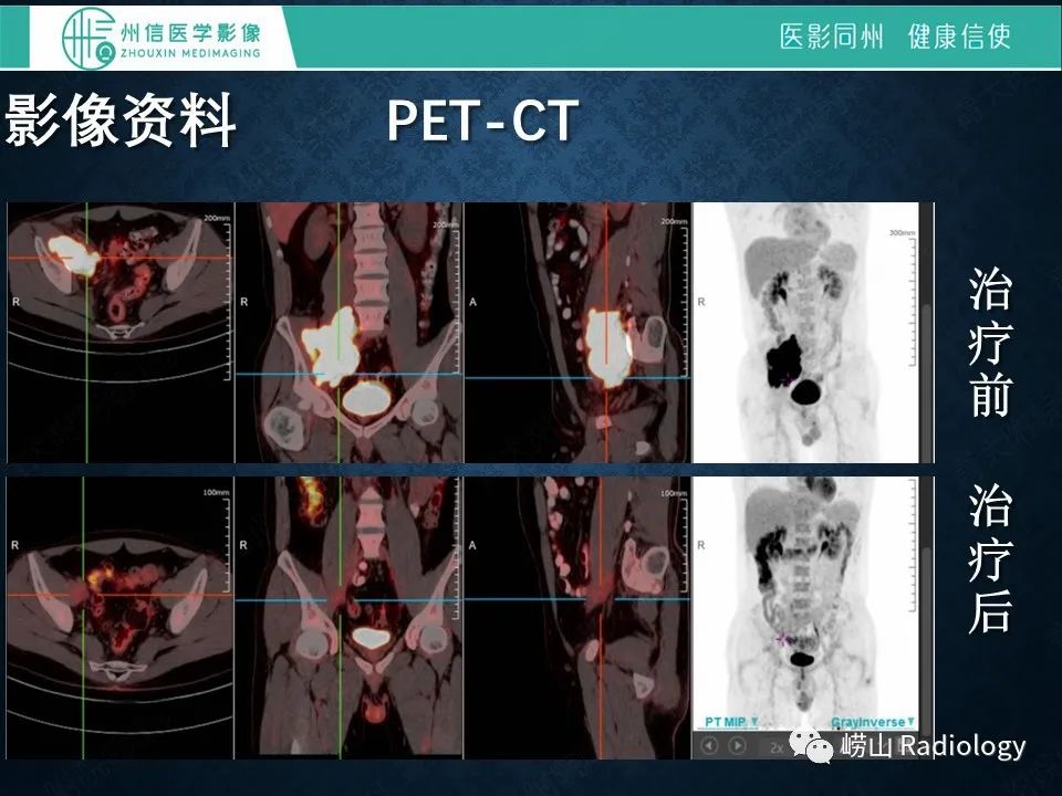 影像PPT - 【病例】腰大肌淋巴瘤1例PET/CT及MR影像-10