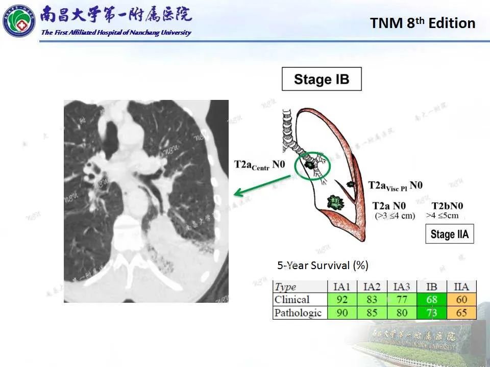 影像PPT - 【PPT】肺癌TNM分期 第8版-7