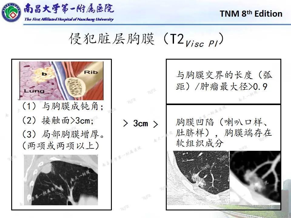 影像PPT - 【PPT】肺癌TNM分期 第8版-8