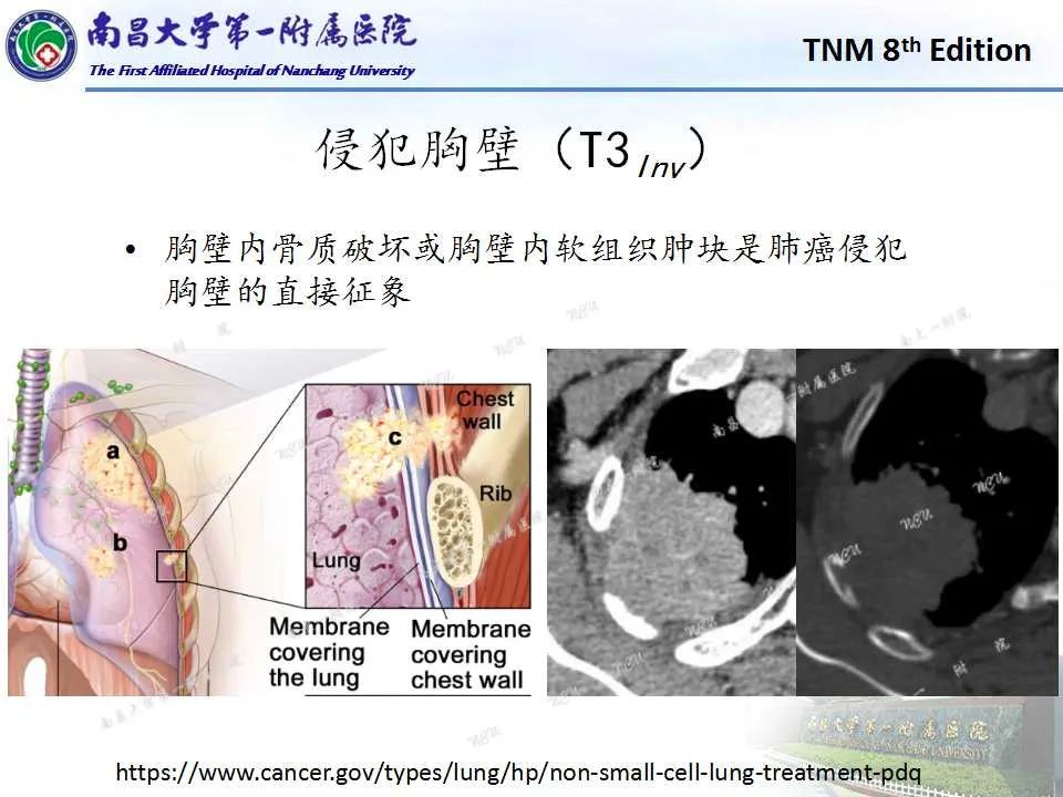 影像PPT - 【PPT】肺癌TNM分期 第8版-9