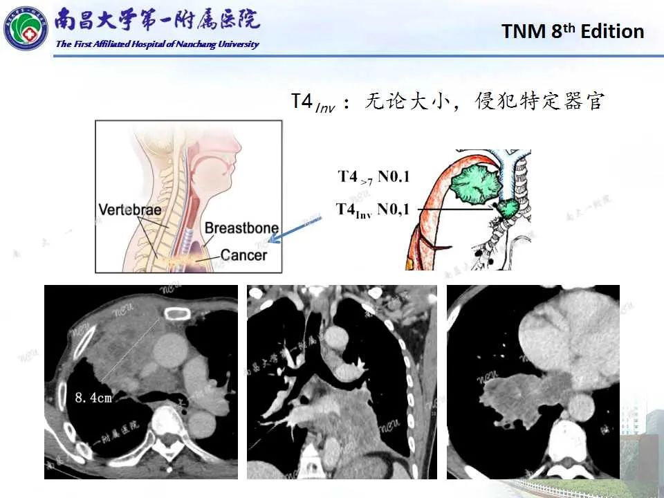 影像PPT - 【PPT】肺癌TNM分期 第8版-11