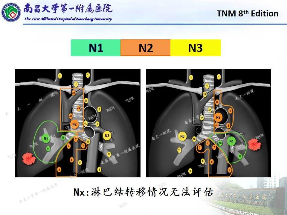 影像PPT - 【PPT】肺癌TNM分期 第8版-12