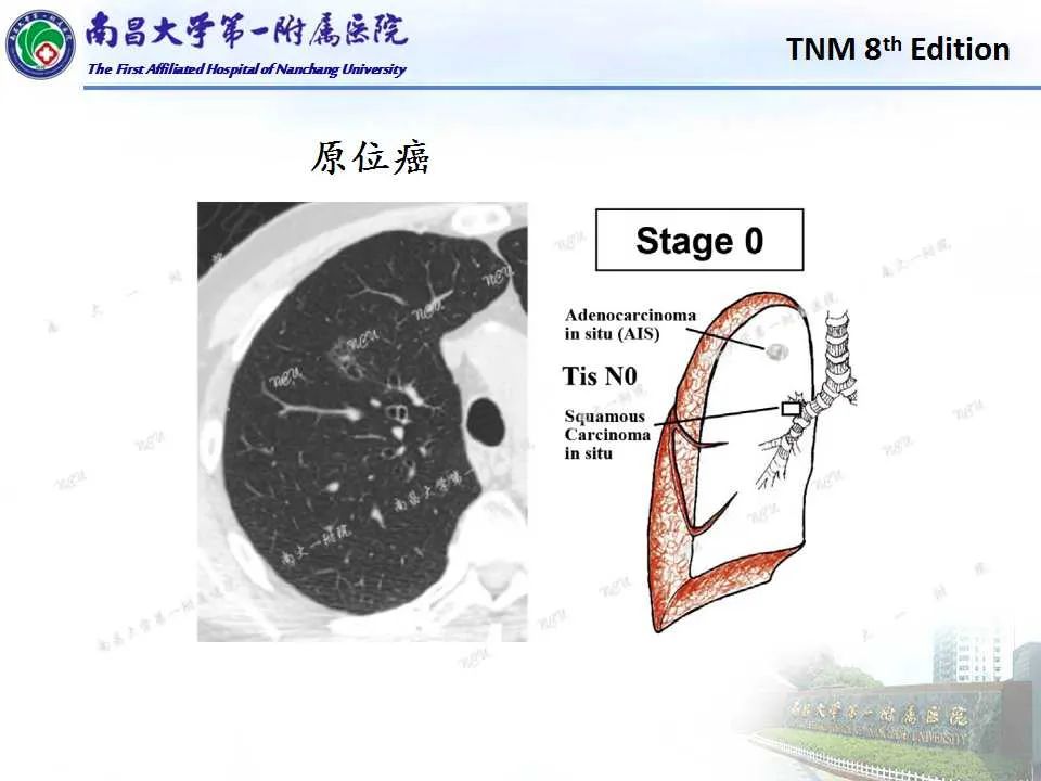 影像PPT - 【PPT】肺癌TNM分期 第8版-16
