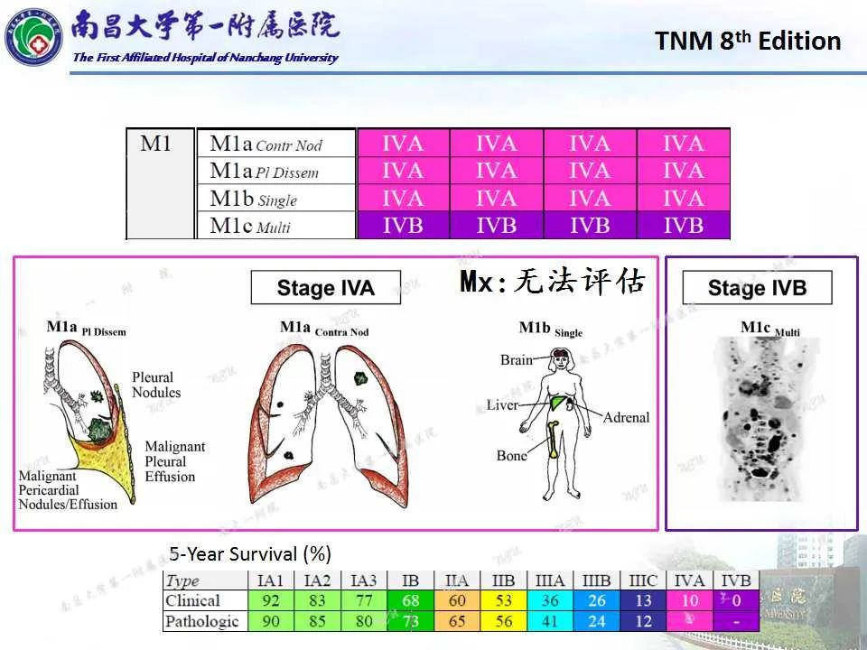 影像PPT - 【PPT】肺癌TNM分期 第8版-15