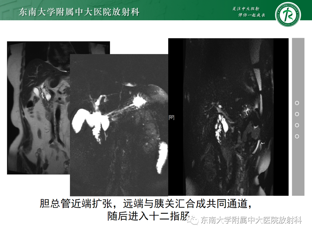影像PPT - 【PPT】胰胆管合流异常-2