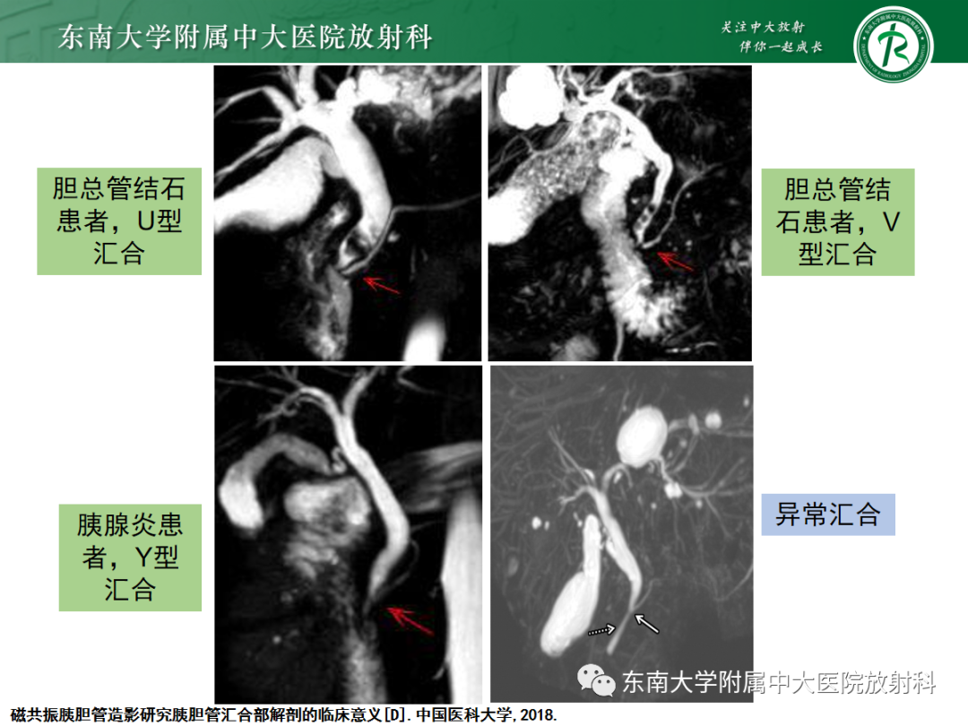 影像PPT - 【PPT】胰胆管合流异常-7