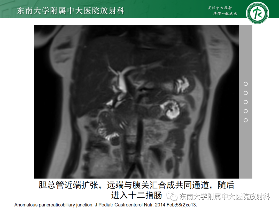 影像PPT - 【PPT】胰胆管合流异常-15