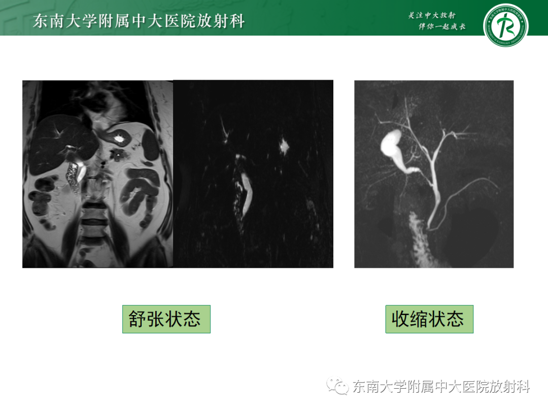 影像PPT - 【PPT】胰胆管合流异常-17