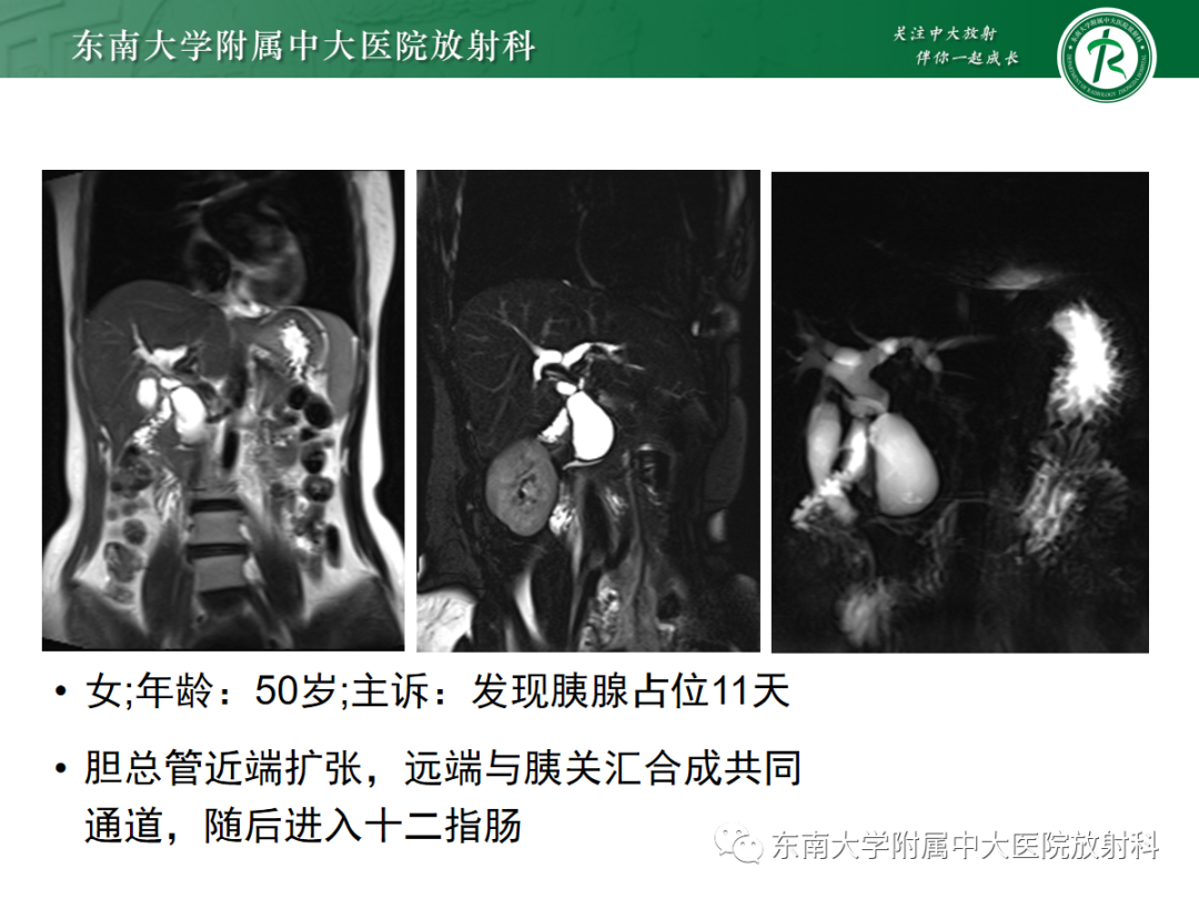 影像PPT - 【PPT】胰胆管合流异常-18