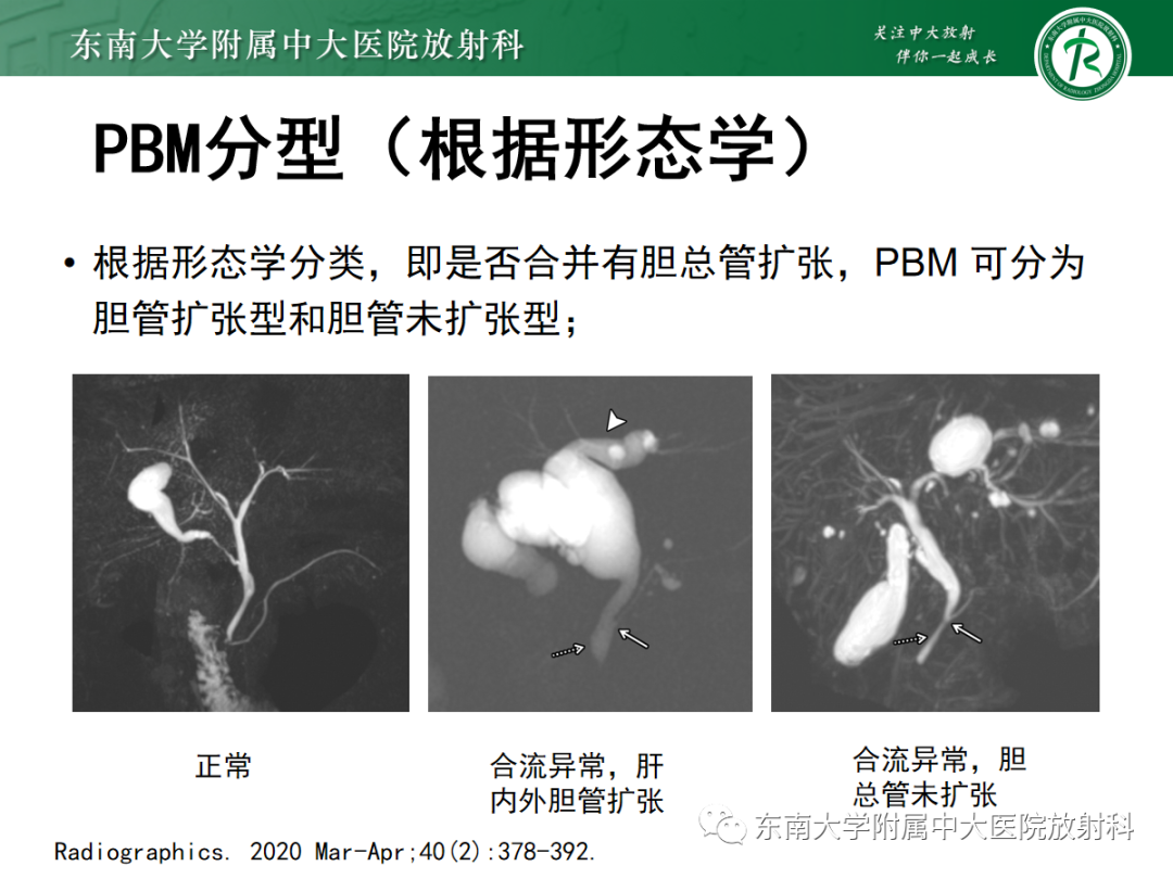 影像PPT - 【PPT】胰胆管合流异常-20