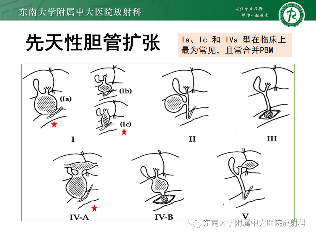 影像PPT - 【PPT】胰胆管合流异常-22