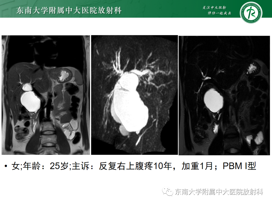 影像PPT - 【PPT】胰胆管合流异常-24