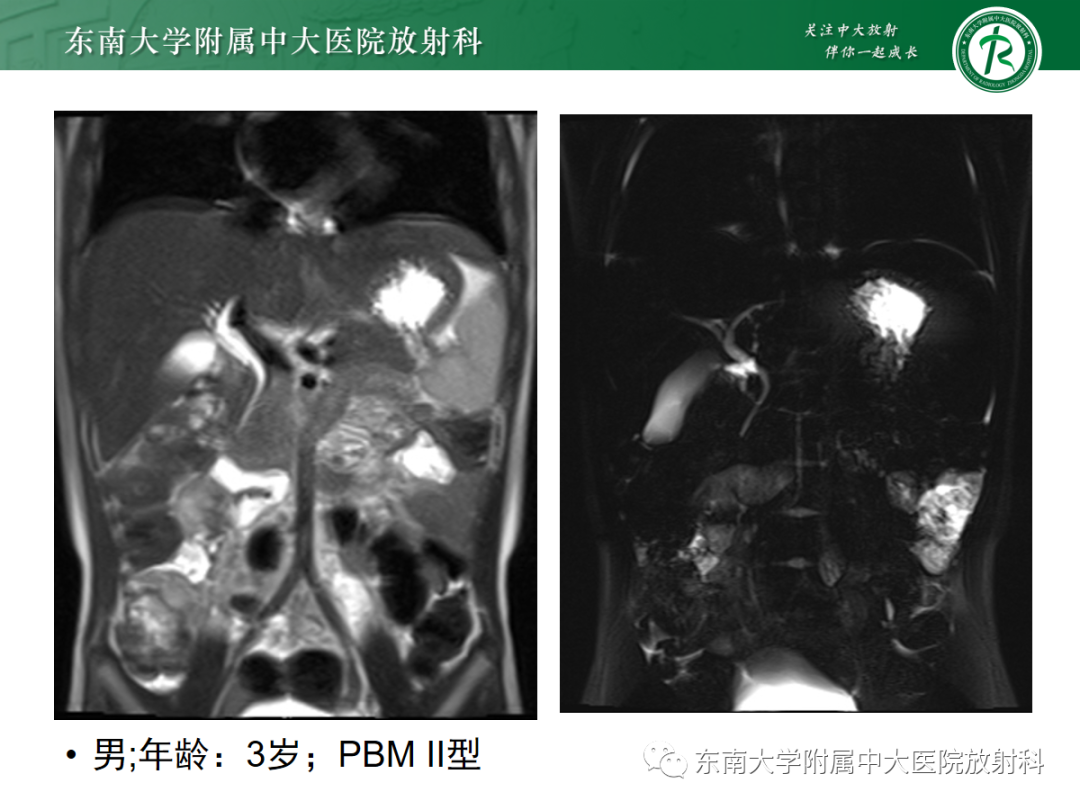 影像PPT - 【PPT】胰胆管合流异常-25