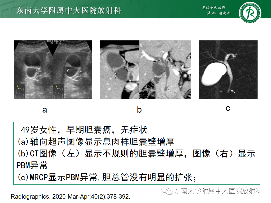 影像PPT - 【PPT】胰胆管合流异常-31