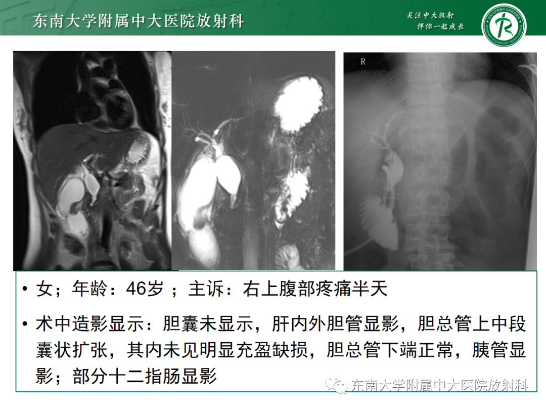 影像PPT - 【PPT】胰胆管合流异常-32