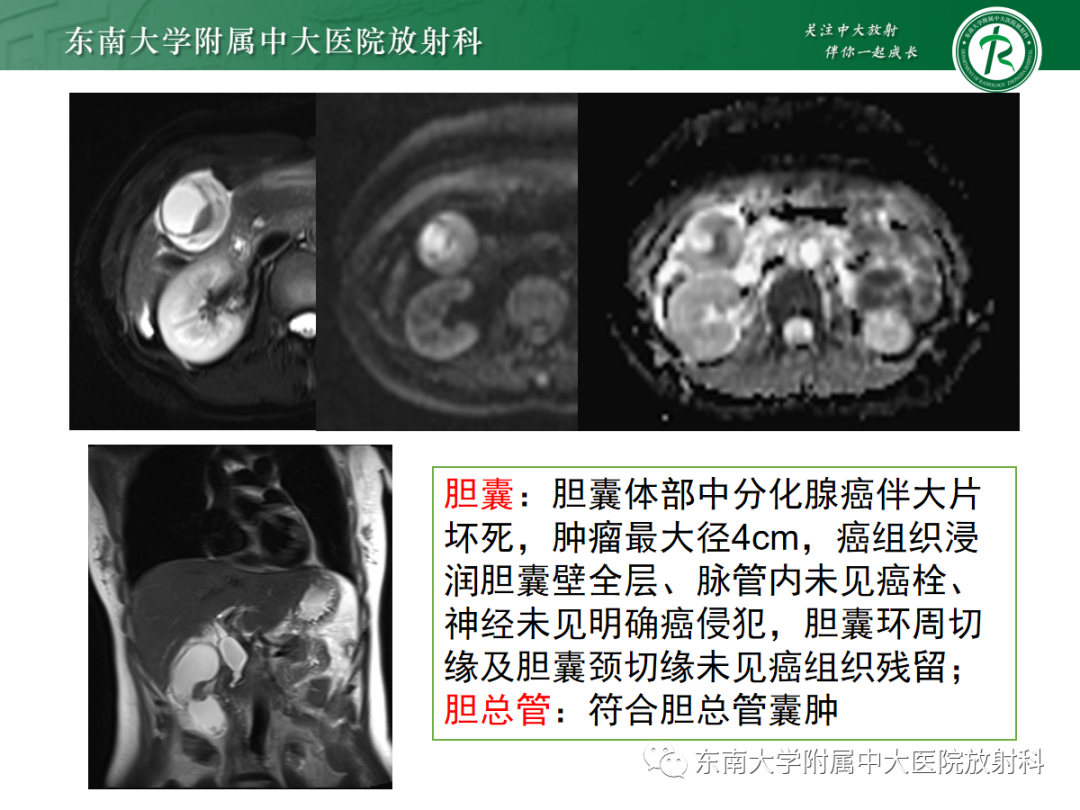 影像PPT - 【PPT】胰胆管合流异常-33