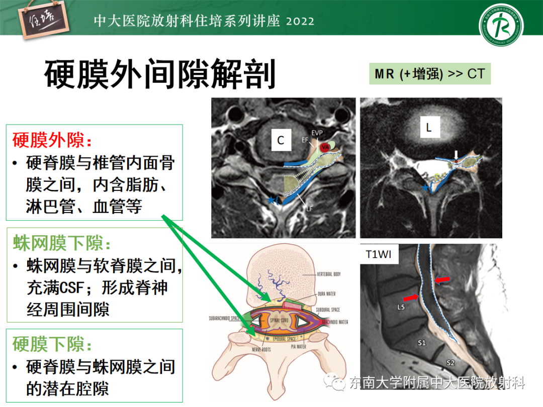 影像PPT - 【PPT】椎管内硬膜外间隙病变影像诊断思路-5