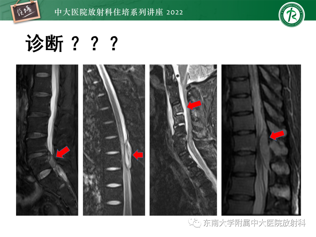 影像PPT - 【PPT】椎管内硬膜外间隙病变影像诊断思路-2
