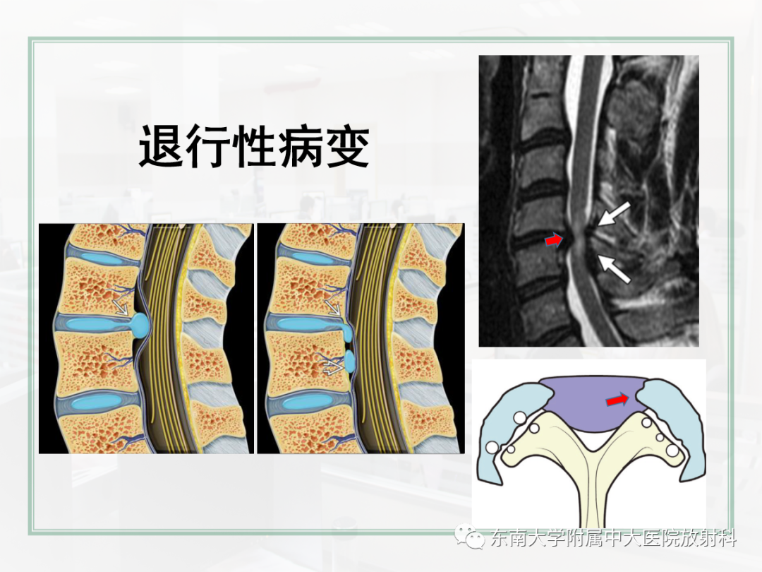 影像PPT - 【PPT】椎管内硬膜外间隙病变影像诊断思路-7