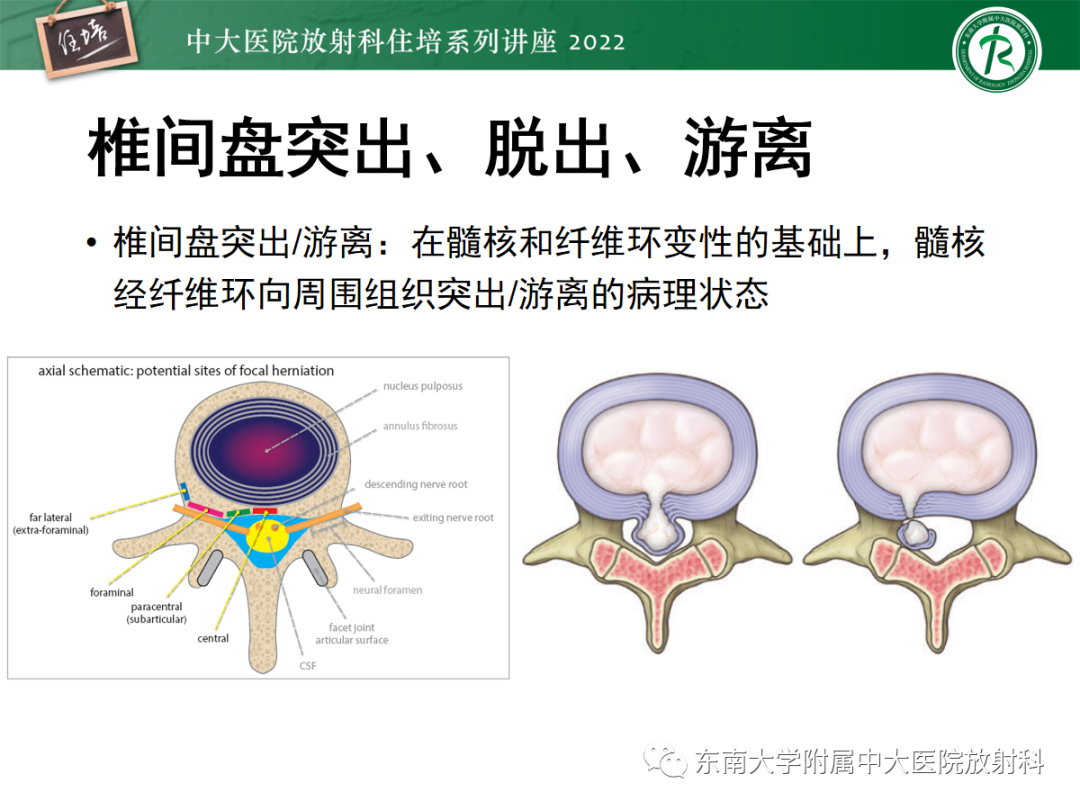 影像PPT - 【PPT】椎管内硬膜外间隙病变影像诊断思路-8