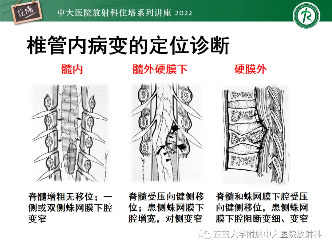 影像PPT - 【PPT】椎管内硬膜外间隙病变影像诊断思路-4