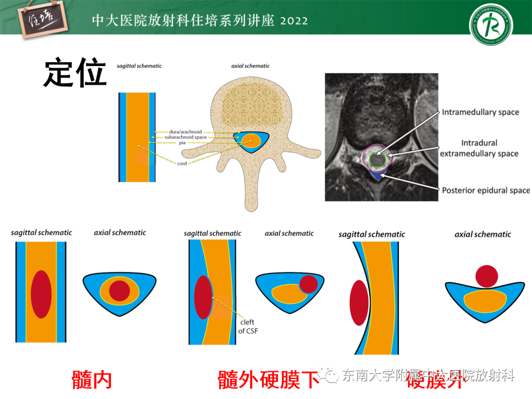 影像PPT - 【PPT】椎管内硬膜外间隙病变影像诊断思路-3