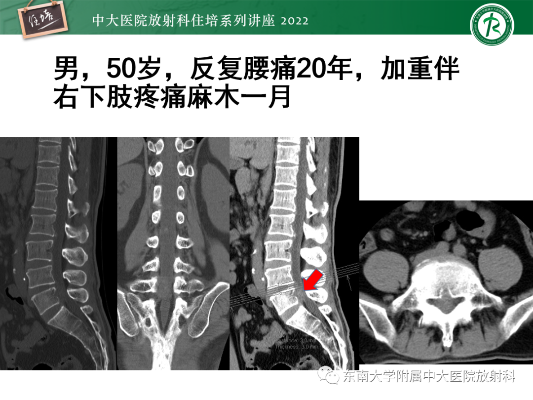 影像PPT - 【PPT】椎管内硬膜外间隙病变影像诊断思路-10