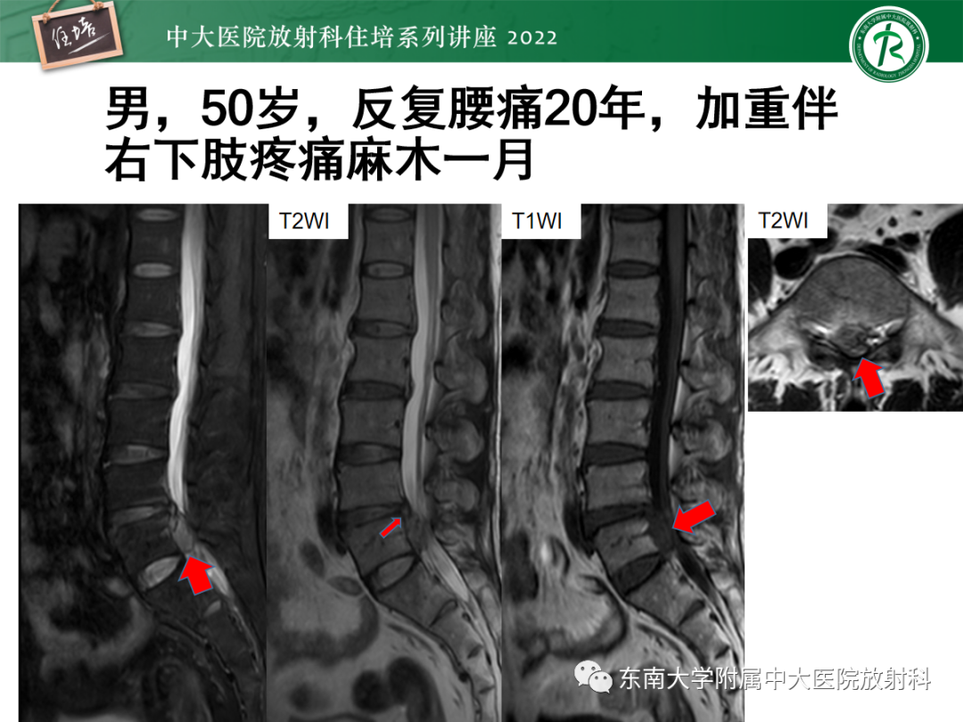 影像PPT - 【PPT】椎管内硬膜外间隙病变影像诊断思路-11