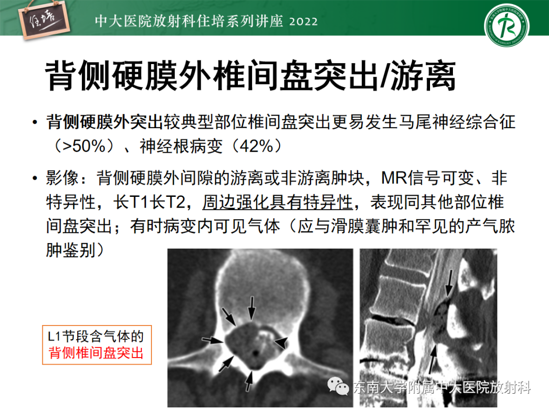 影像PPT - 【PPT】椎管内硬膜外间隙病变影像诊断思路-15