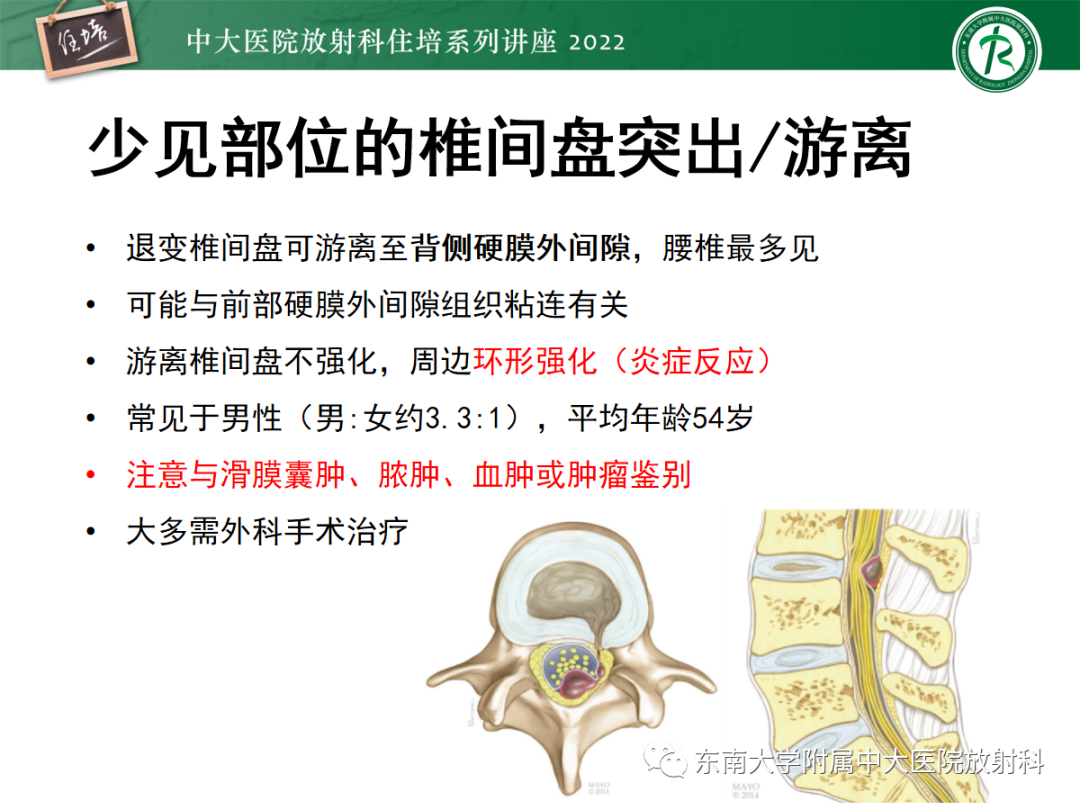 影像PPT - 【PPT】椎管内硬膜外间隙病变影像诊断思路-14