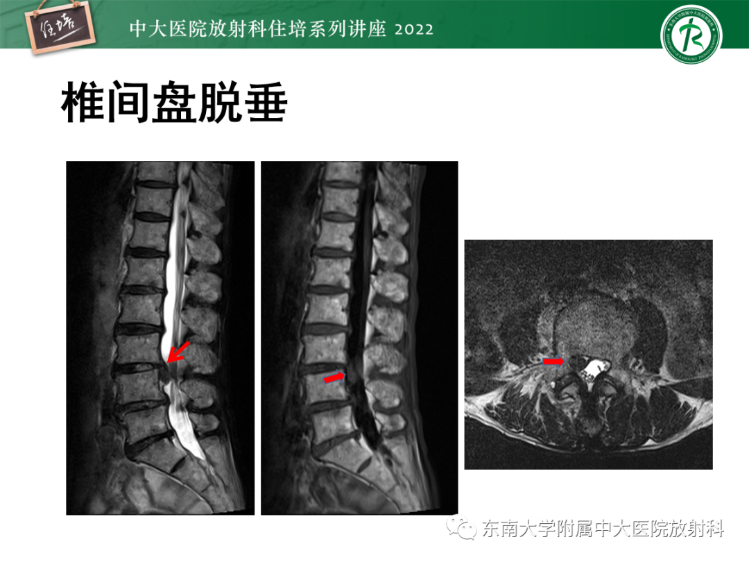影像PPT - 【PPT】椎管内硬膜外间隙病变影像诊断思路-13