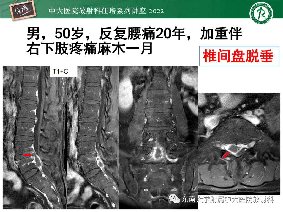 影像PPT - 【PPT】椎管内硬膜外间隙病变影像诊断思路-12