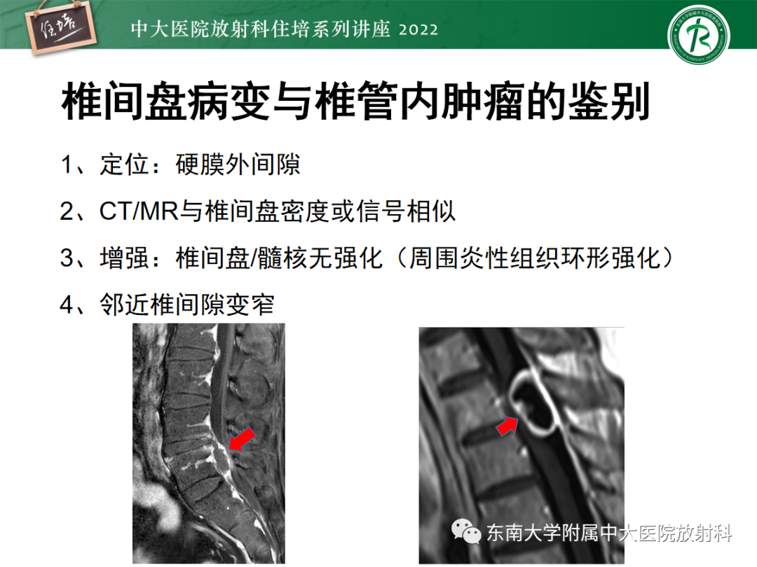 影像PPT - 【PPT】椎管内硬膜外间隙病变影像诊断思路-17