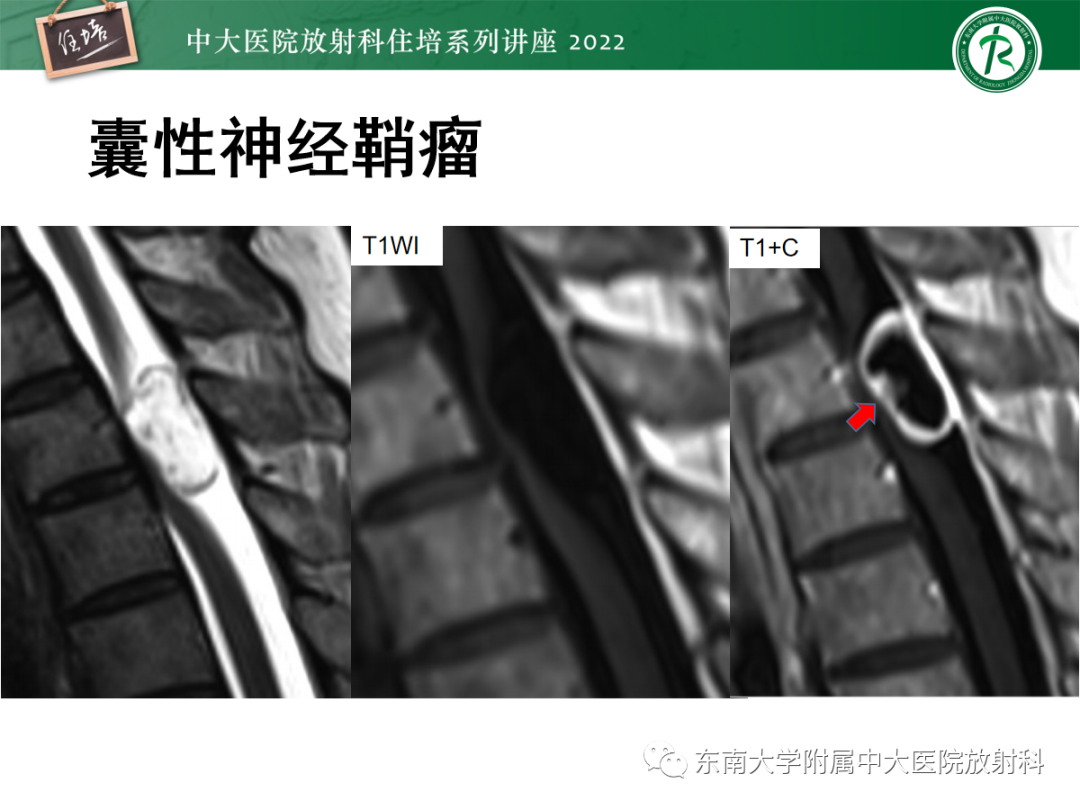 影像PPT - 【PPT】椎管内硬膜外间隙病变影像诊断思路-19