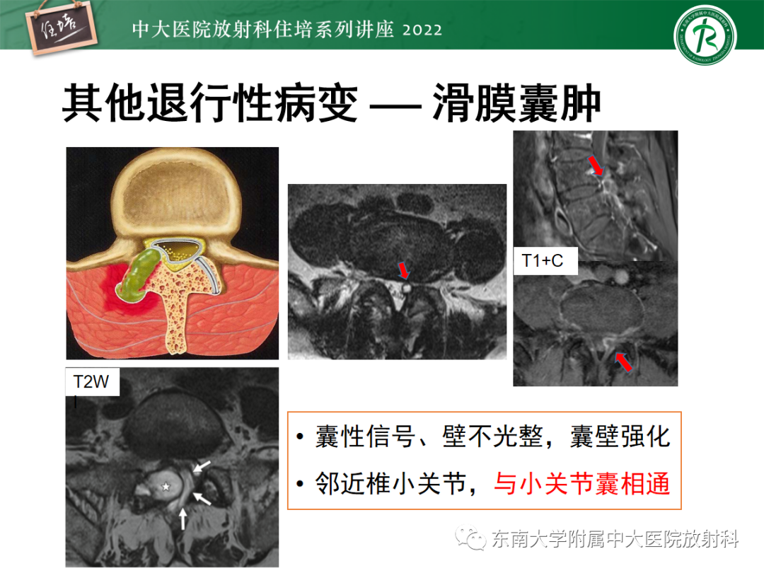 影像PPT - 【PPT】椎管内硬膜外间隙病变影像诊断思路-20