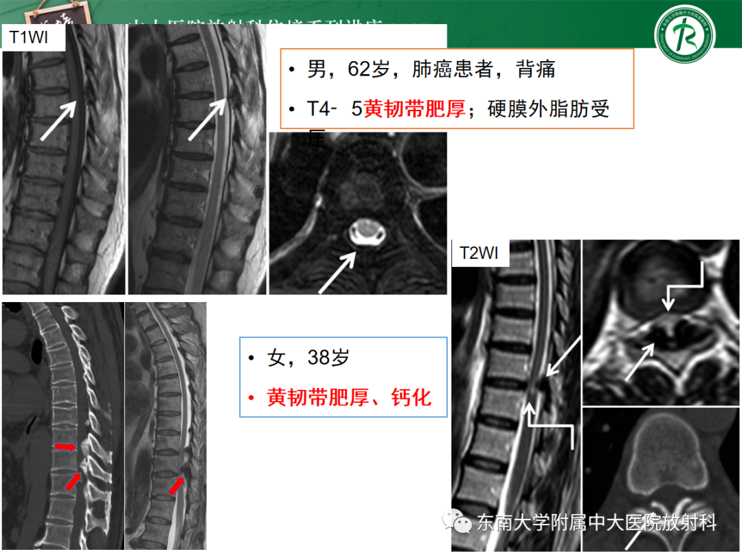 影像PPT - 【PPT】椎管内硬膜外间隙病变影像诊断思路-21
